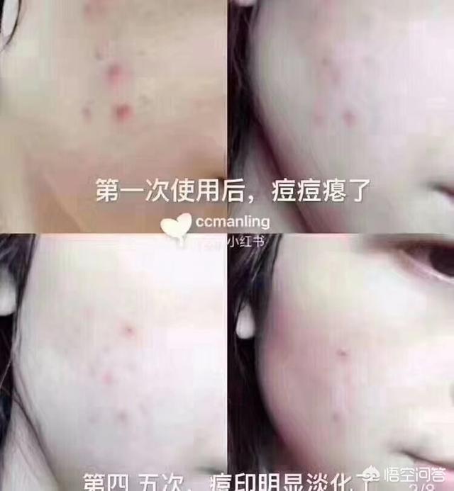 去痤疮面膜(去痤疮面膜牌子)