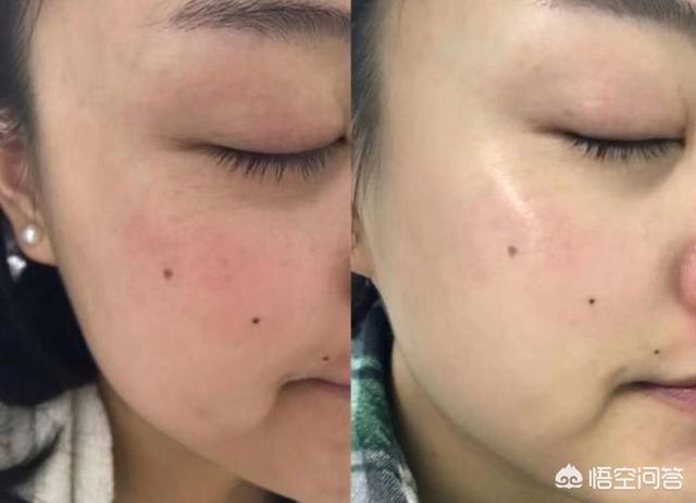 去痤疮面膜(去痤疮面膜牌子)