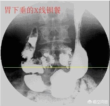 头条问答- 胃下垂是由什么原因引起的？(小克大夫的回答，0赞）
