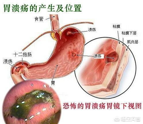 消化道溃疡:得了消化性溃疡，在生活中应该注意些什么？