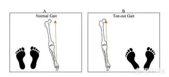 外八字可以改吗:宝宝走路有点外八字怎么纠正？