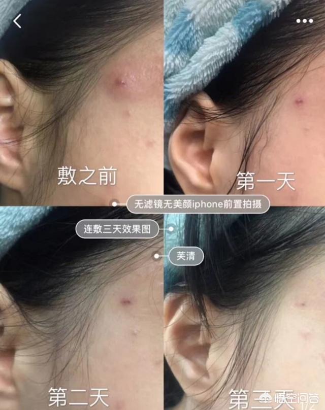 去痤疮面膜(去痤疮面膜牌子)