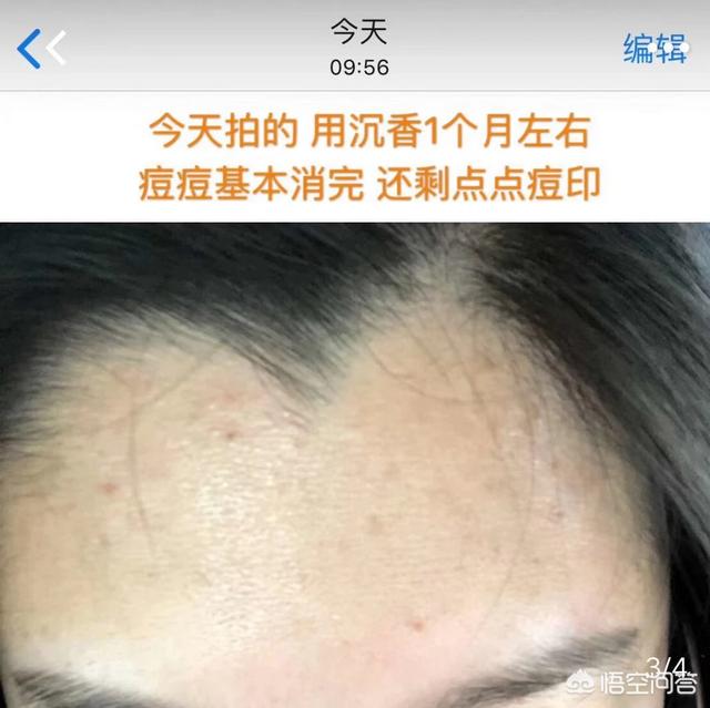 去痤疮面膜(去痤疮面膜牌子)