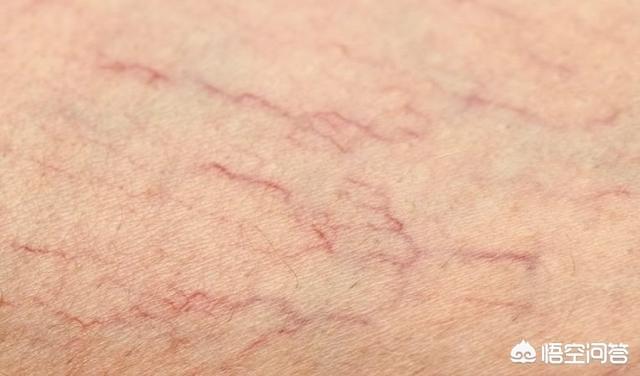 小腿部有红血丝腿上有红血丝怎么办,是不是毛细血管破裂了,还是其他