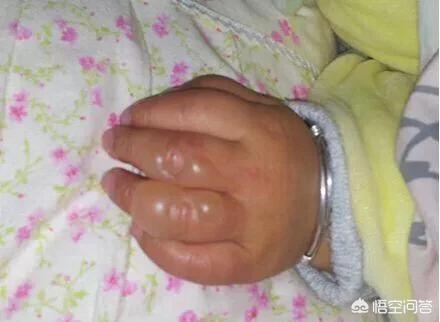 student 小龙猫足:如果宝宝不小心被烫伤了，第一步要做什么？