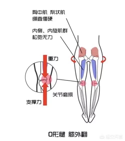 o型腿怎么办(怎么矫正o型腿)