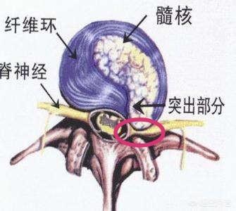 疼痛科怎样治疗神经根炎:神经根受压了，该怎么办？