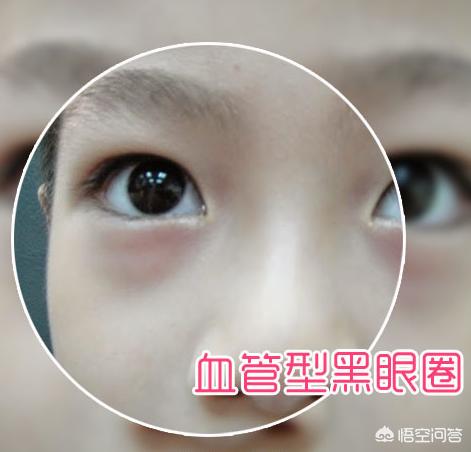 黑眼圈做手术大概需要多少钱:整容医院里的哪些医疗措施对黑眼圈有效果？要开刀吗？