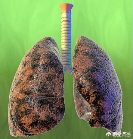 5年烟龄肺部图片图片