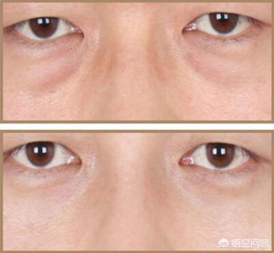 怎样消除眼袋又快又好维生素e去眼袋可行吗