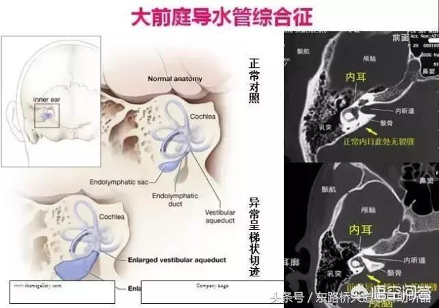 耳部结构图耳内骨迷路及膜迷路:人的耳朵内耳有哪些生理结构和功能？