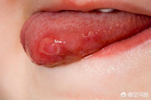儿童口腔溃疡症状:儿童口腔溃疡是什么引起的 经常性口腔溃疡是种什么体验？