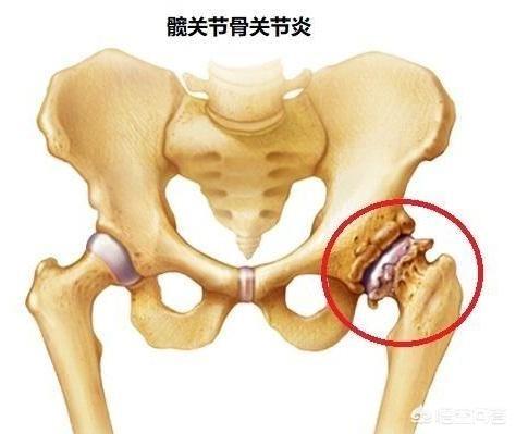 莱姆病症状:有哪些疾病会导致关节痛？