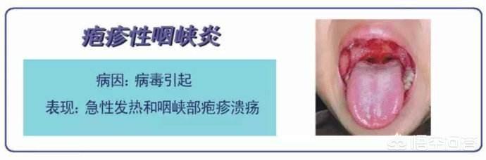 宝宝常见口腔问题:0到3岁宝宝常见的问题 宝宝口腔溃疡，嘴里有泡，不愿意吃饭，只肯喝奶该怎么办？