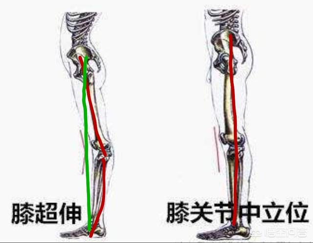 瑜伽如何才能矫正“膝超伸”？