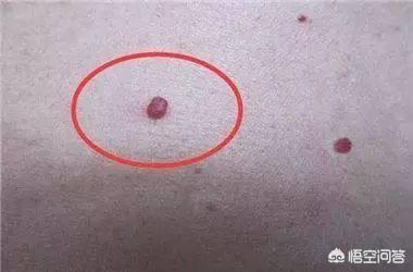 乳房上长了颗血痣是什么原因？应该怎么办？