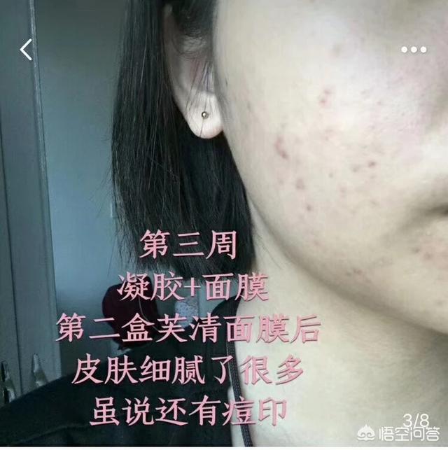 头条问答 有什么去闭口粉刺的办法吗 皮肤美容miss潘的回答 0赞