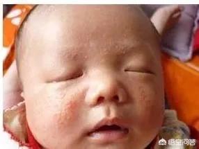 4个月的宝宝有湿疹，有什么办法？