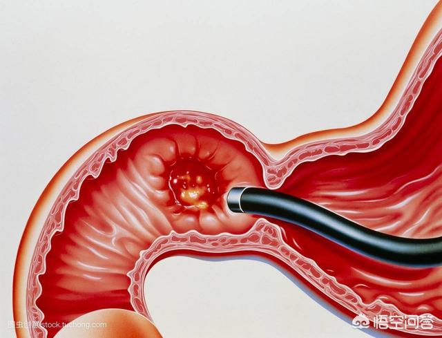 急性胰腺炎的治疗药品:急性胰腺炎的治疗药 胆囊结石引发急性胰腺炎，该怎么治疗？需要切除胆囊吗？