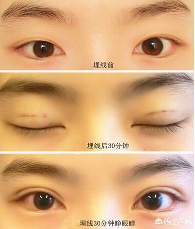 玉镯纳米无痕修复技术,纳米无痕和埋线，有什么不一样？