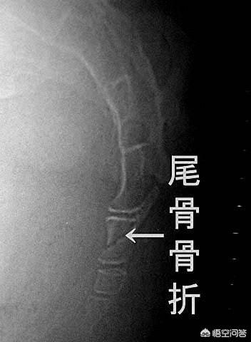 女生尾巴根疼是什么原因:尾巴骨根部酸痛，应该怎么办？