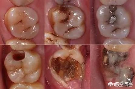 龋齿是怎么产生的?-惠修网