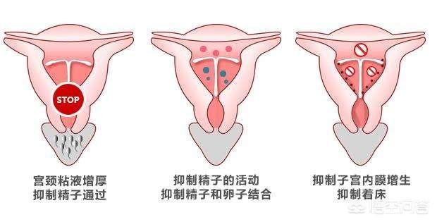 为啥带环后易发生宫外孕，女性上环后一定不会意外怀孕吗上环后对身体有哪些不可避免的影响