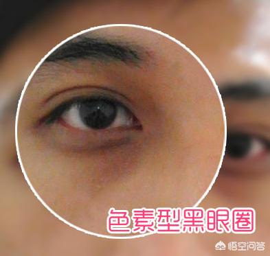 黑眼圈做手术大概需要多少钱:整容医院里的哪些医疗措施对黑眼圈有效果？要开刀吗？