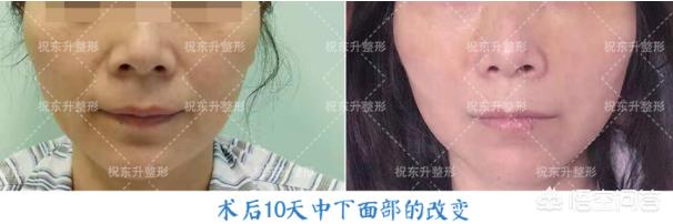 怎样消除眼袋又快又好维生素e去眼袋可行吗