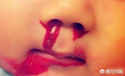 小孩鼻子出血怎么回事：小孩子鼻子经常出血什么原因