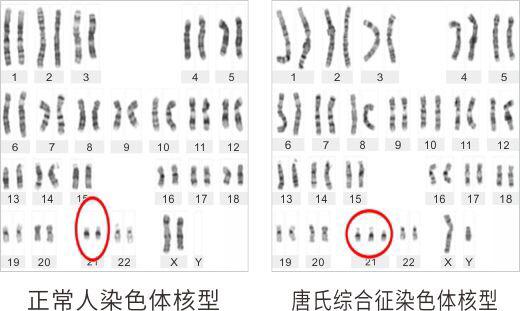 遗传病有哪些:遗传病有哪些会致死 遗传病有多少种？哪些病会遗传下一代？