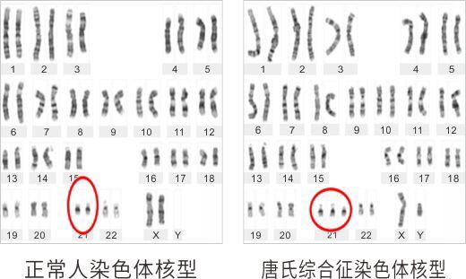 显性基因遗传病有哪些:有哪些遗传病在成年以后才开始发病？