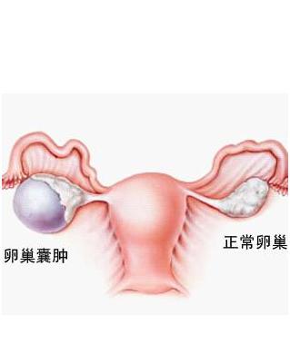 卵巢囊肿的治疗方法:卵巢囊肿的治疗方法及注意事项 卵巢囊肿食疗方法有什么？