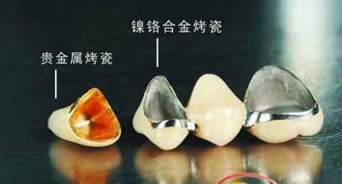 烤瓷牙齿分为哪几种:烤瓷牙齿多少钱一个 镶烤瓷牙为什么那么多种价位，材质差的多吗？