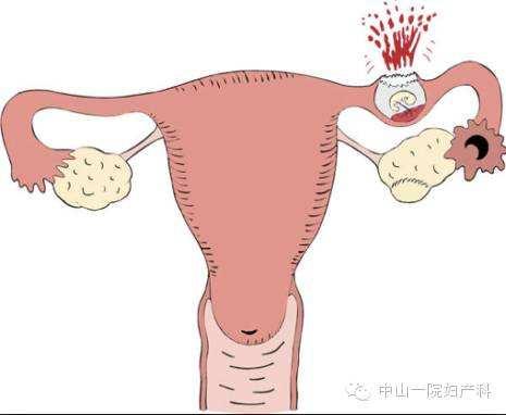 腹腔镜手术后注意事项:腹腔镜切除输卵管手术后注意事项 宫外孕腹腔镜手术后多久可运动？