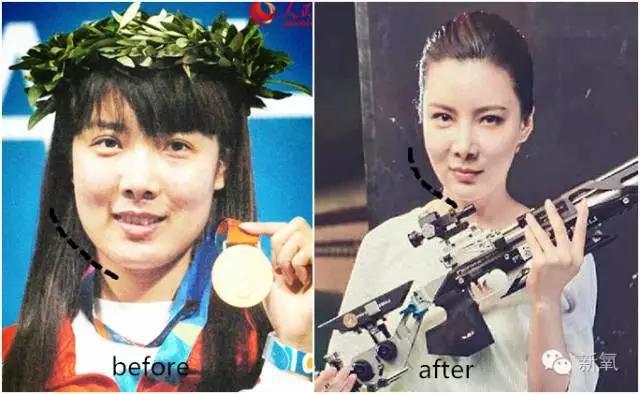 韩国明星整容失败:你们有没有见过或者听说过一些整容失败的案例？