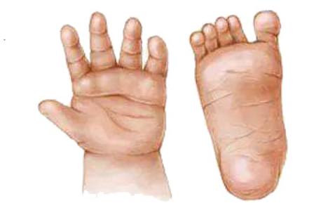 唐氏综合症有什么特征如何辨别宝宝是不是唐氏综合症