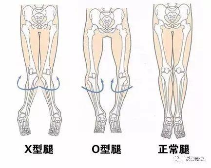 罗圈腿是什么图片