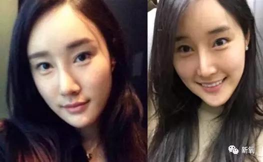 崔始源的妹妹:整容上瘾或者过度整容会对人有什么影响？