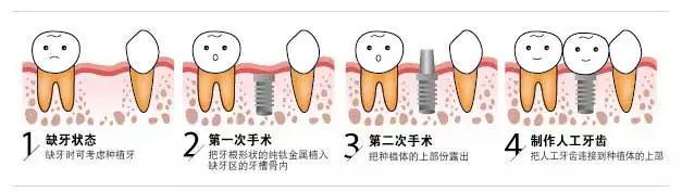 头条问答 做种植牙一般要多久才能种好 用户62358320685的回答 0赞
