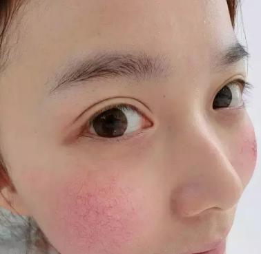 疤痕性体质(疤痕性体质是什么原因导致的)