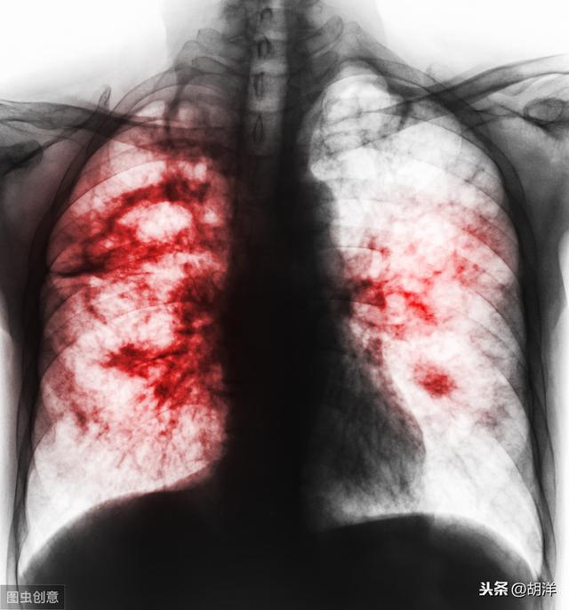 肺癌8x3cm严重吗：肺部结节8mmx6mm，严重吗？