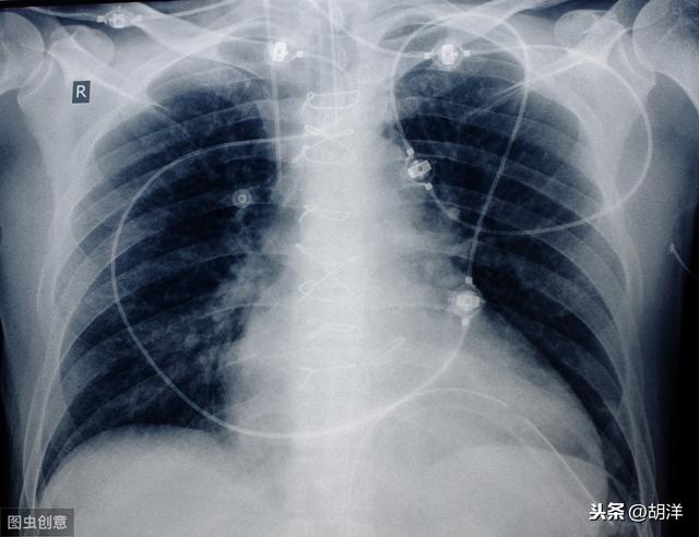 贺岩去世的具体情况如何，肺癌患者一般都是怎么去世的