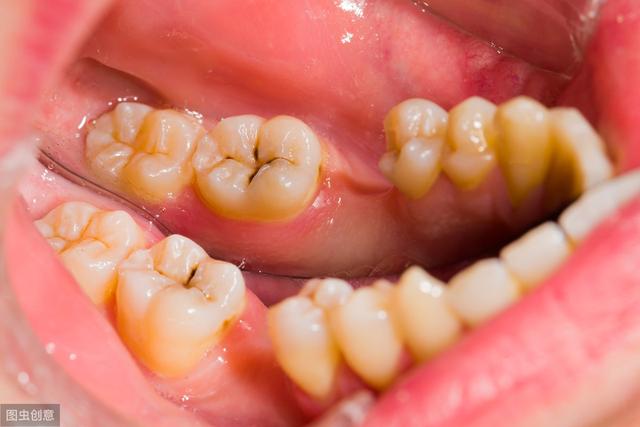 虫牙怎么来的你长过虫牙吗牙痛是一种怎样的经历