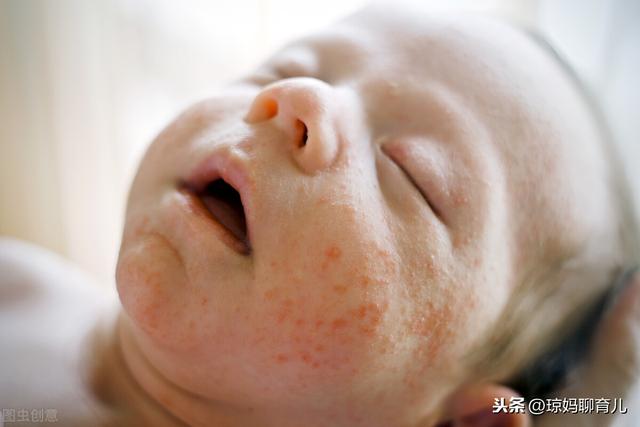 小宝宝为什么会出现枕秃，奶粉喂养的九个月宝宝后脑勺头发稀少，是缺钙了吗