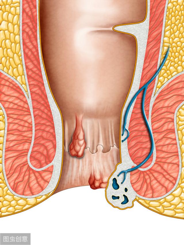 混合痔临床描述:混合痔临床表现类型