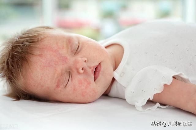 4个月的婴儿身上长满了湿疹，头上和脖子都很严重，该怎么治疗？