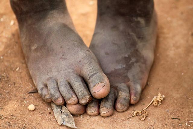 蛆虫疗法是真的吗，非洲人脚上长的寄生虫自己不会处理吗为何要等志愿者去帮忙处理