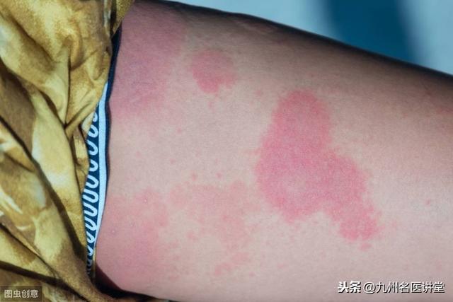 皮肤过敏和荨麻疹的区别？