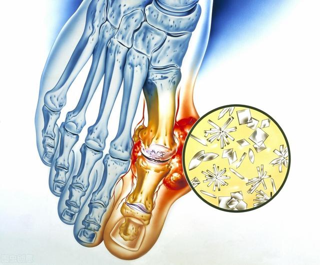 急性手指关节炎怎么治疗:手指关节肿、胀、痛，吃什么药好？